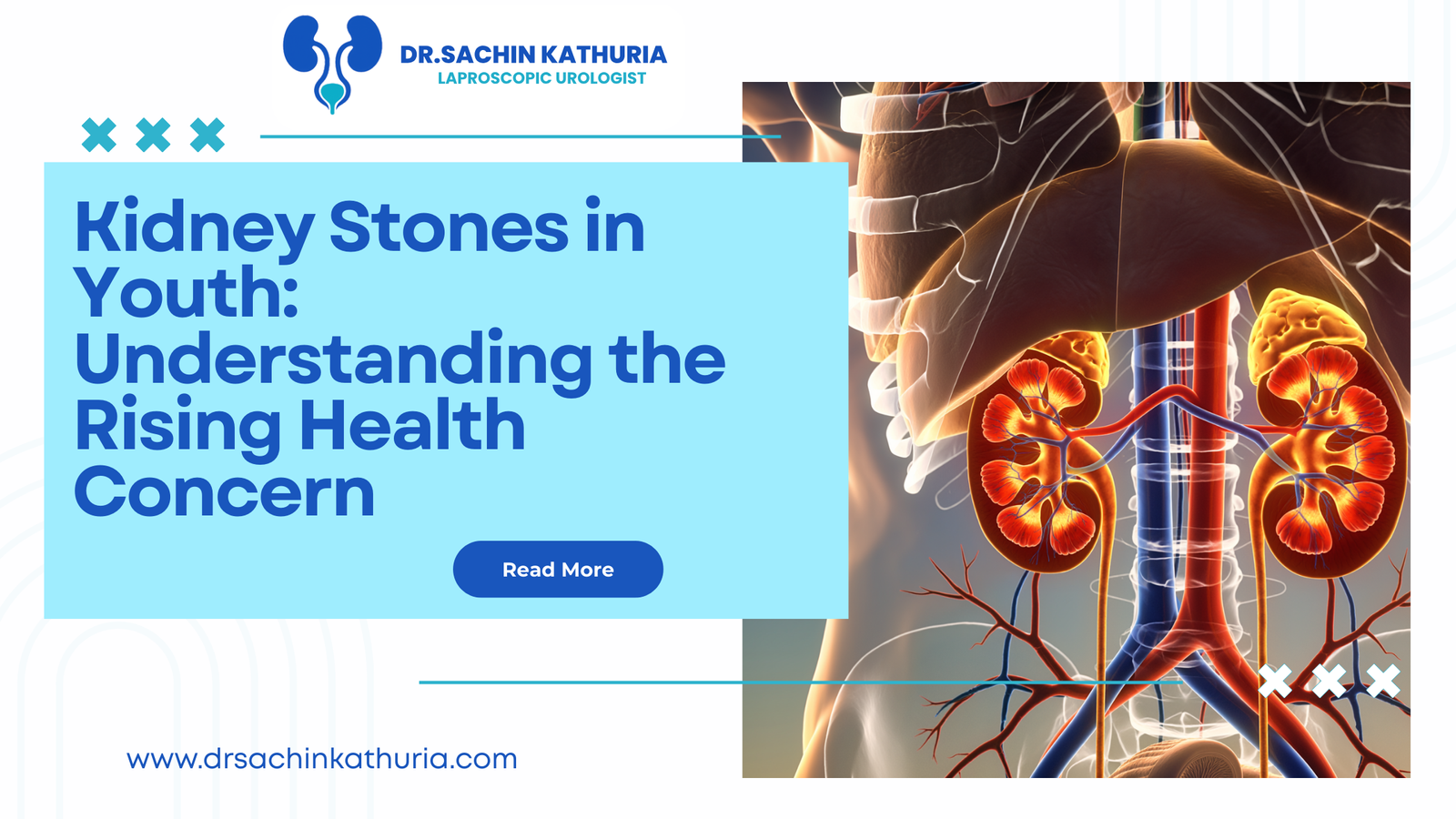 Kidney Stones in Youth Understanding the Rising Health Concern
