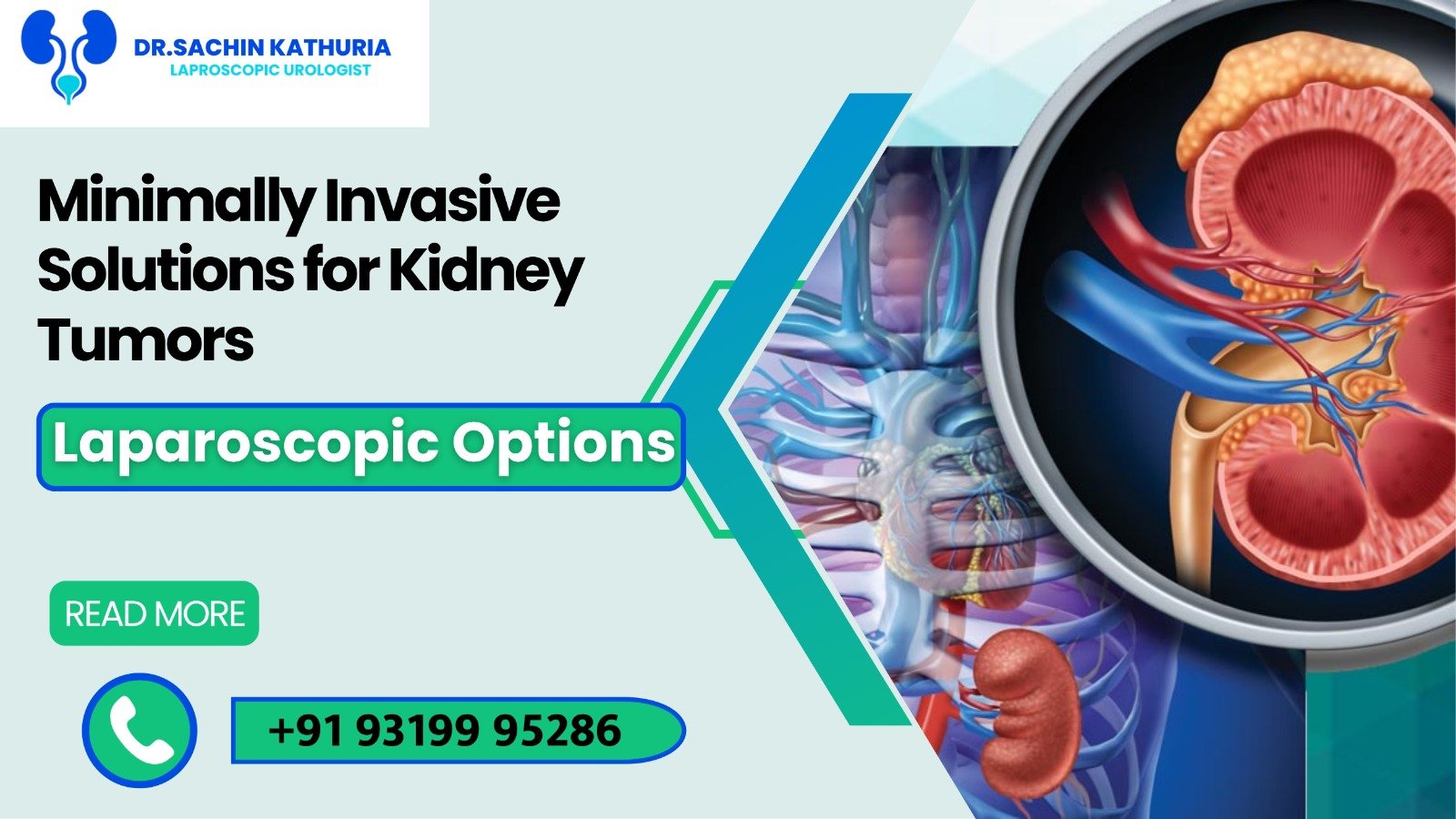 Minimally Invasive Solutions for Kidney Tumors: Laparoscopic Options