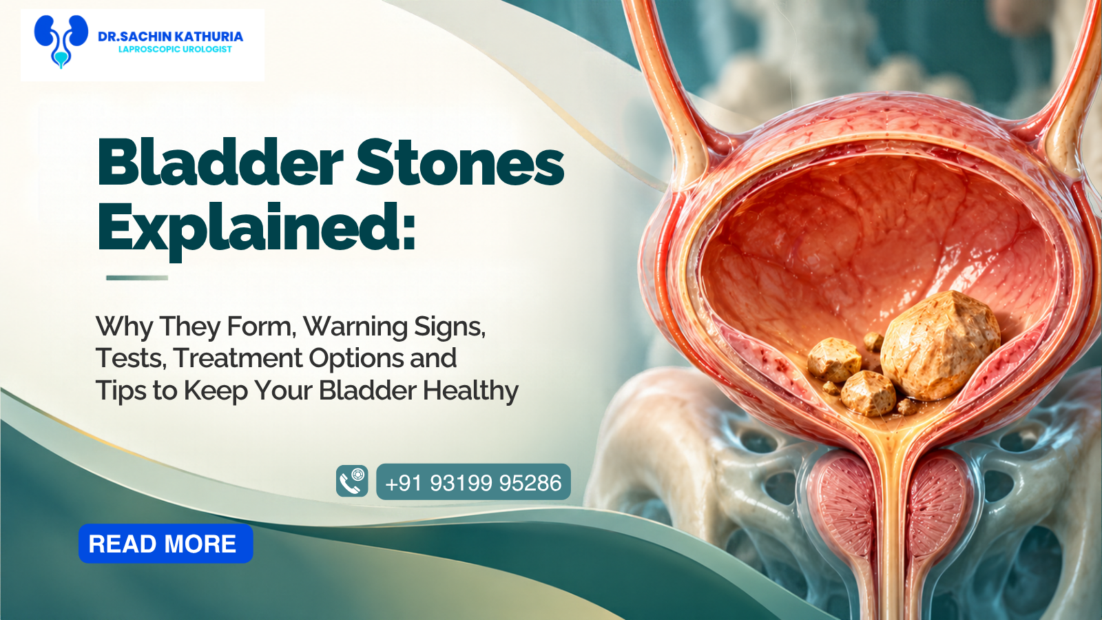  Illustration of a human bladder with bladder stones
